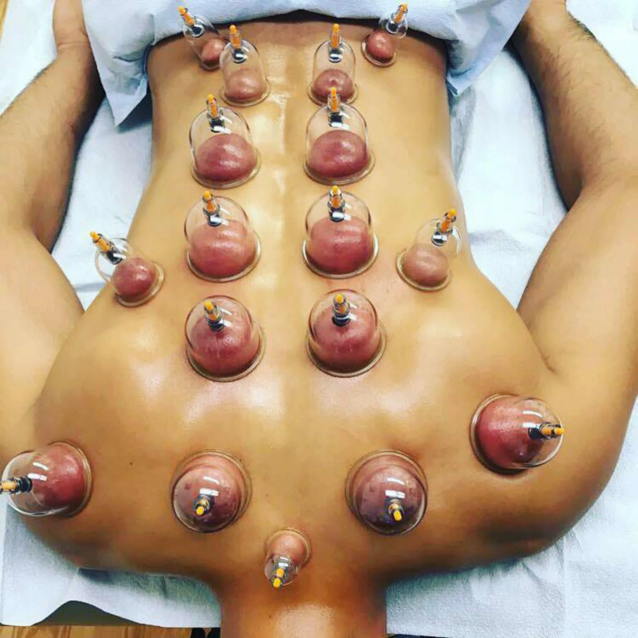 Hijama